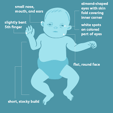 Down Syndrome Signs Symptoms And Characteristics
