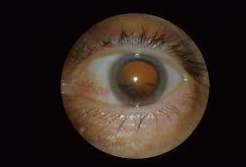 How To Diagnose And Grade Cataracts Eyeguru