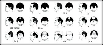 Norwood Scale Assess Your Hair Loss With Pics Celebrity