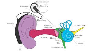 What Do Cochlear Implants And Hearing Aids Sound Like
