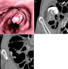 the ileocecal valve springerlink