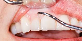 what s causing your gums to look white