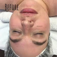 Microneedling is collagen induction therapy. Microneedling Wound Healing Theskinteach