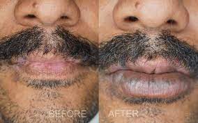 permanent lip color correction