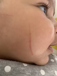 scratch on the face babycenter