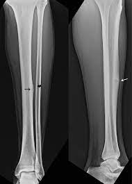 stress fractures in shins and lower