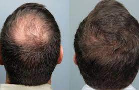 stem cell therapy for hair regrowth at