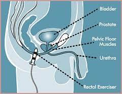 pelvic floor electrical stimulation therapy