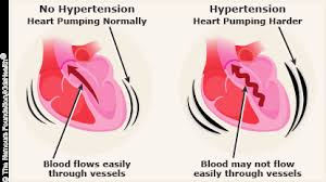Hypertension High Blood Pressure For Parents Nemours