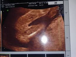 Usg atau ultrasonografi adalah pemeriksaan yang penting melalui usg, dokter dan ibu hamil dapat mengetahui kondisi janin dalam kandungan. Jenis Kelamin Bayi Dari Usg Ibuhamil Com