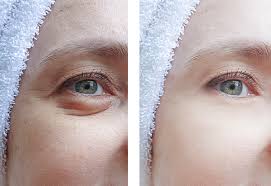 treat eye bags using light therapy and