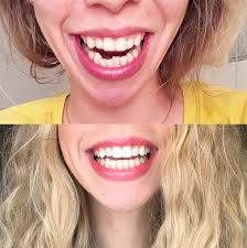 A support group for questions and discussion on the topic of braces! Reddit How Long Did It Take Smile Direct Club Delivery Good Smile Direct Review