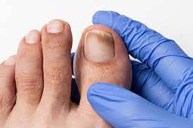 first sign of toenail fungus