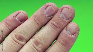 ugly pogryzannye fingers biting nails