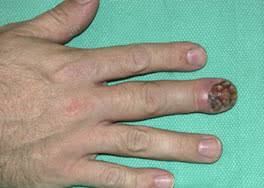 disorders of the nail orthopaedia