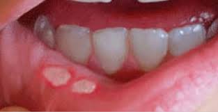 Es gibt die sogenannten bläschen auf der zunge. Weisse Wunden Im Mund Oder Leukoplakie Dr Jamilian