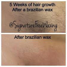 At senzera you will find this treatment. Top Photos 5 Weeks Of Hair Growth After Receiving A Brazilian Wax At Signature Free Waxing Bottom Photo After Receivi Brazilian Waxing Hair Growth Top Photo