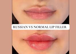 russian lip filler technique vs normal