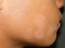 What does it look like? Pityriasis Alba Symptoms Causes Diagnosis And Treatment