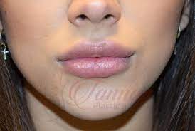 lip fillers tannan plastic surgery