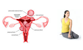 uterine fibroids yoga therapy union