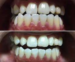 teeth whitening sparklesmile teeth