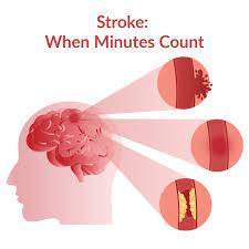 first aid for stroke beaumont