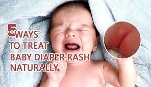 home remes to your child diaper rash