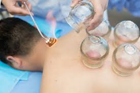 Cupping Lovie Acupuncture And Healing