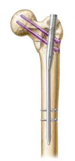 hip fracture fixation femur proximal