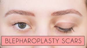my blepharoplasty scars faqs cost