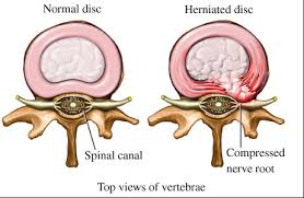 herniated disc