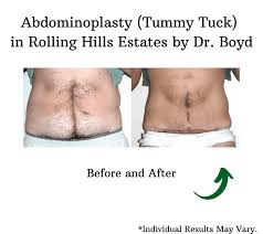 abdominal liposuction vs tummy tuck