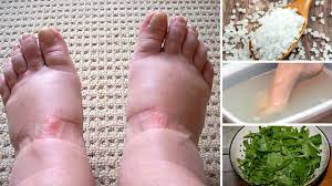 home remes for swollen feet you