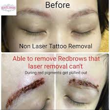 We are here to give you the facts and information you need on. Non Laser Tattoo Removal