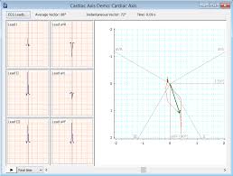 Ecg Cardiac Axis Deviation Heart Axis Deviation Calculator