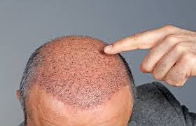 healing time after hair transplant dr