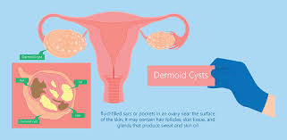 what is dermoid cyst its type