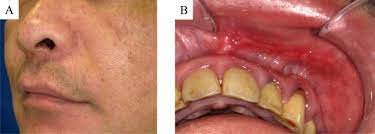dermoid cyst arising in the upper lip