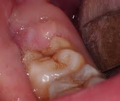 get rid of wisdom tooth pain case