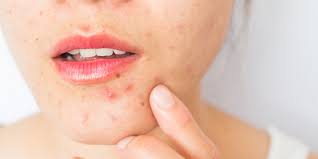 cystic acne dermatologists explain