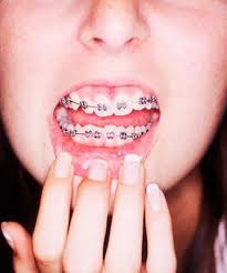 Anytime you are putting metallic towards your enamel, you danger scratching the tooth. Diy Braces Trend Risks And Dangers