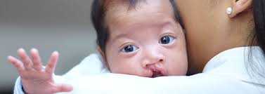 baby with cleft lip or palate