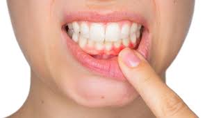 what is the best cure for gum disease