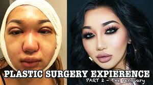How much is chin lipo uk. My Plastic Surgery Story Pt 2 Double Eyelid Rhinoplasty Chin Liposuction Youtube
