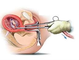 Image result for abortion in kenya