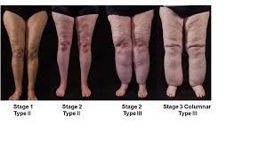 subcutaneous adipose tissue diseases