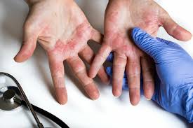 hand eczema causes symptoms and treatment