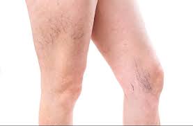 what spider veins say about your health