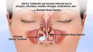 deviated nasal septum treatment